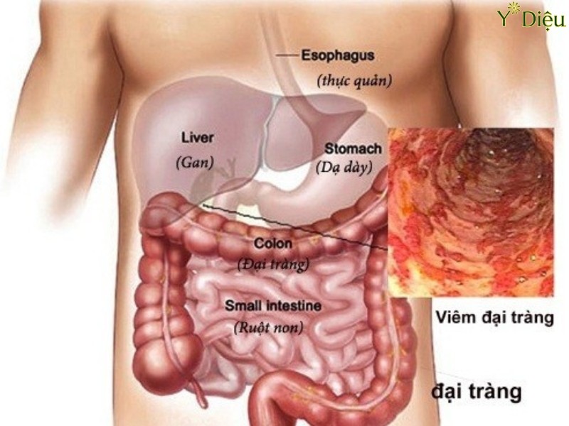Viêm Đại Tràng Mạn Tính: Nguyên Nhân Và Phương Pháp Điều Trị